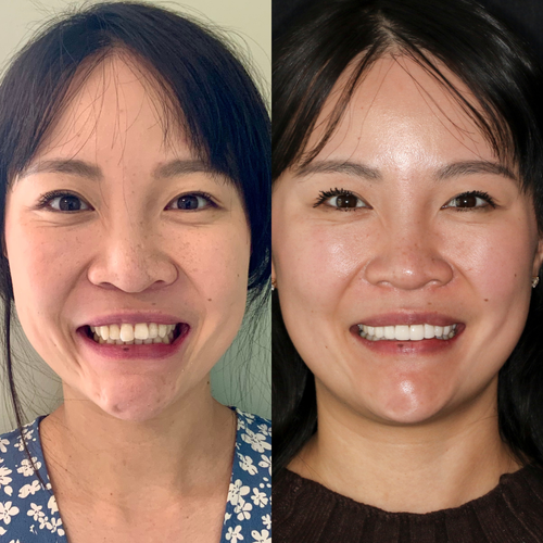 veneers