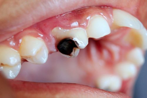 Tooth decay - Wikipedia