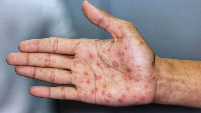 Secondary syphilis palmar lesions