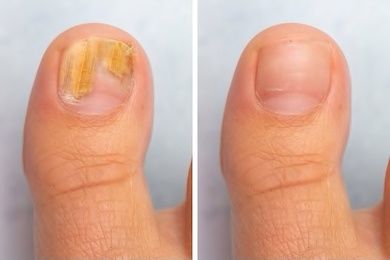 Fungal nail treatment results