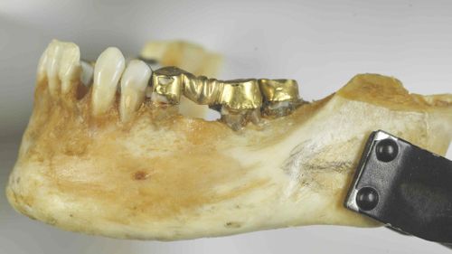 The Isdal Woman's lower jaw, courtesy of Norwegian police