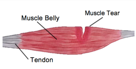 muscle tear treatment