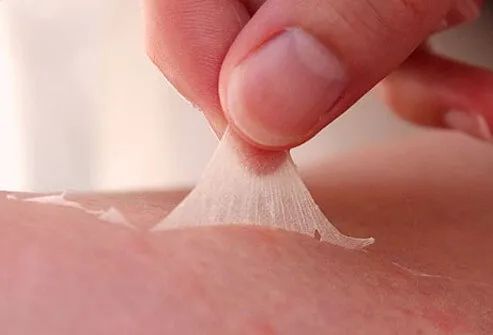 Sunburn of the First Degree