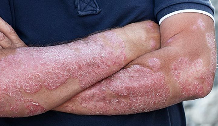 S'en débarrasser du psoriasis naturellement