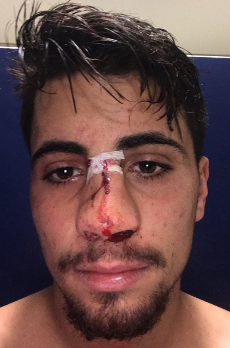 Fabio Cardoso confirms the defender broke his nose against Motherwell