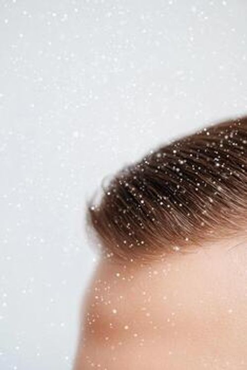 Scalp examination revealing dandruff flakes on healthy hair strands in natural light photo
