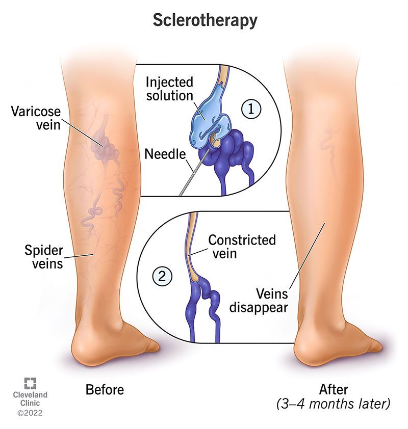 Injecting a chemical to close off a varicose vein.