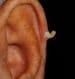 Cutaneous Horn