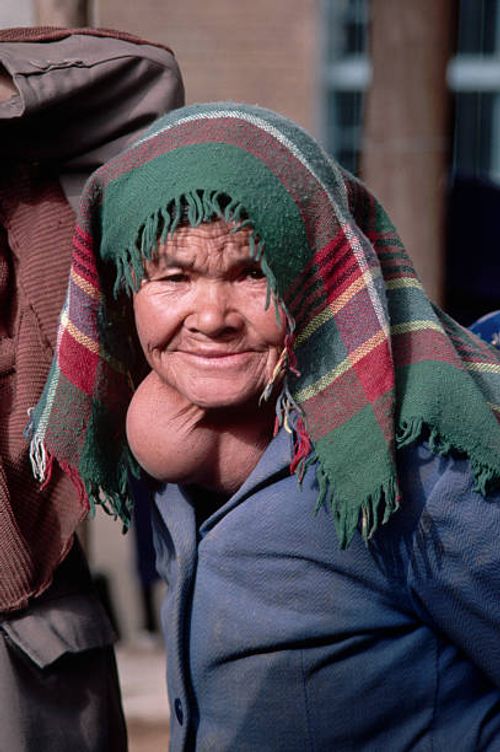 goiter on elderly uighur woman - goiter stock pictures, royalty-free photos & images