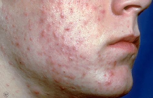 Menino com cistos de acne