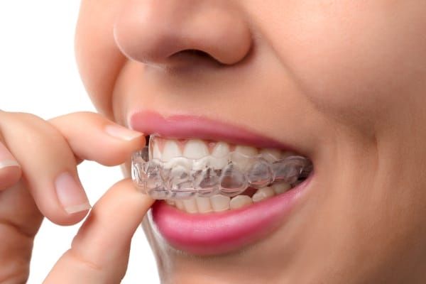 Clear aligner treatment at Goldendale Dental Care