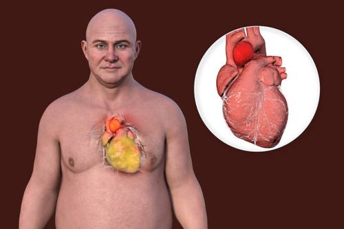 fatty heart and aortic aneurysm, illustration - aneurysm stock illustrations