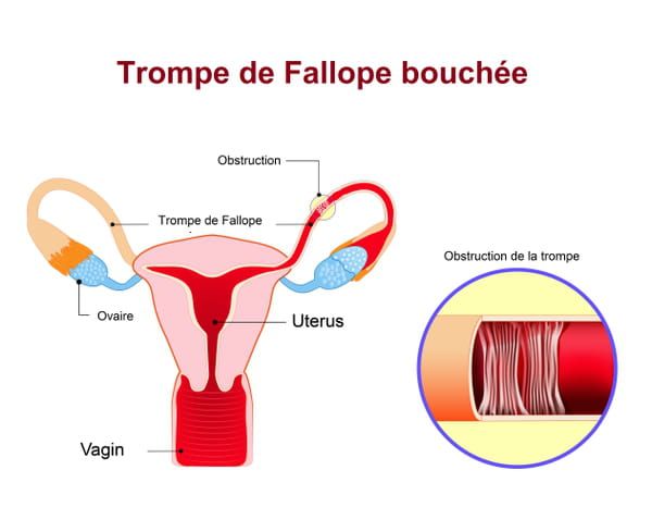 Déboucher les trompes de fallope naturellement