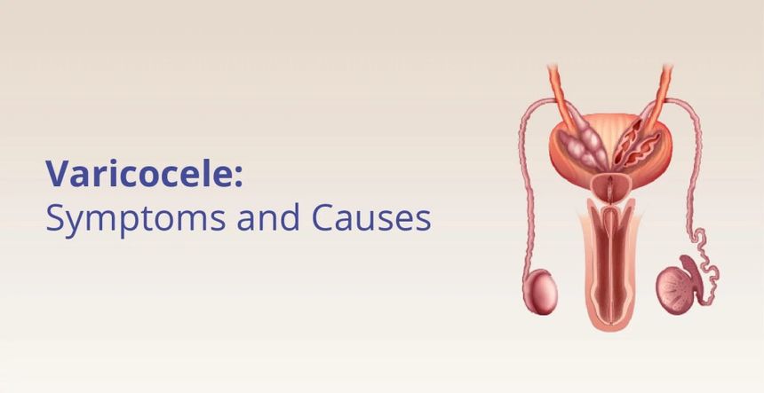 What is Varicocele? Varicoceles: Diagnosis, Symptoms & Treatment -Varicocelectomy
