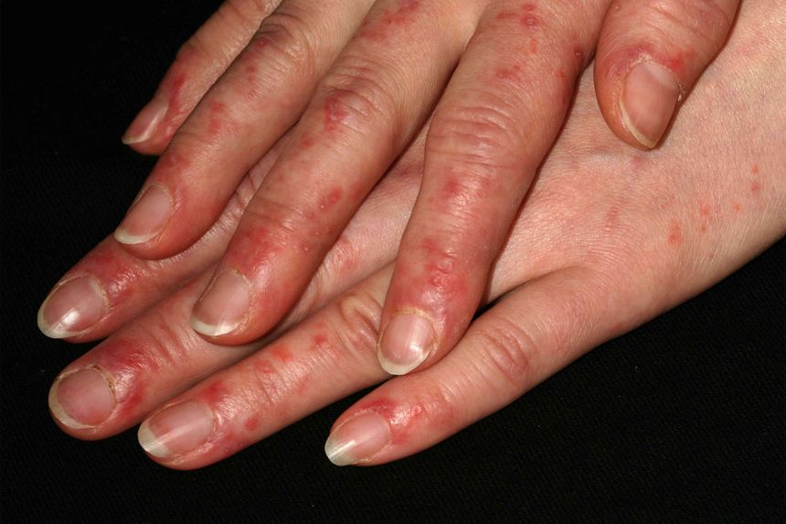 Lupus recette naturelle