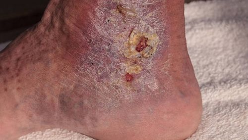 Medical picture: Infection cellulitis on the skin Medical picture: Infection cellulitis on the skin of an ankle caused by phlebitis and blood clots in the vein.  cellulitis stock pictures, royalty-free photos & images