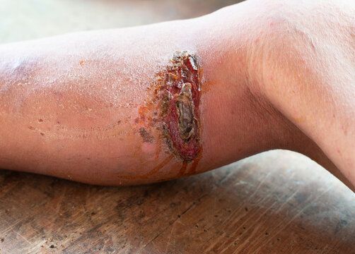 Lesões cutâneas com inflamação da ferida infectada