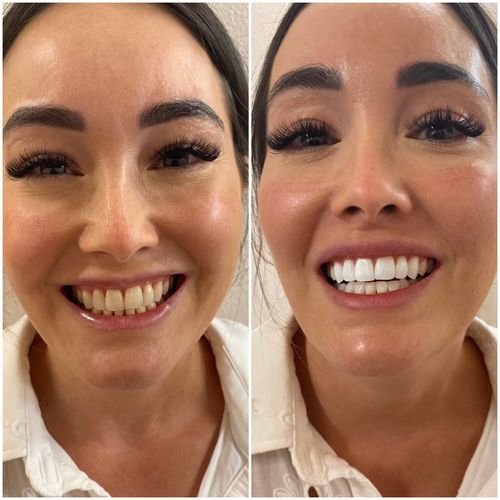 whitening
