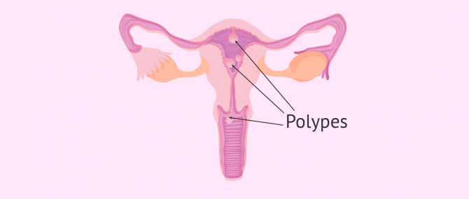 Polype endométrial recette naturelle