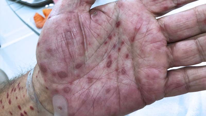 Secondary syphilis - Reddish purple spots on the palms