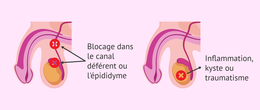 Azoospermie sécrétoire soin naturel