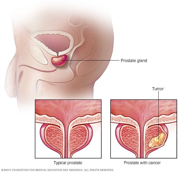 Soin naturel du cancer de prostate