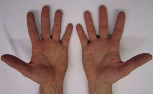 Rash on palms of the hands