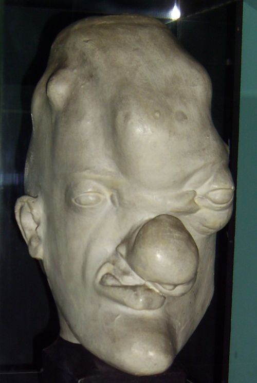 tertiary syphilis head