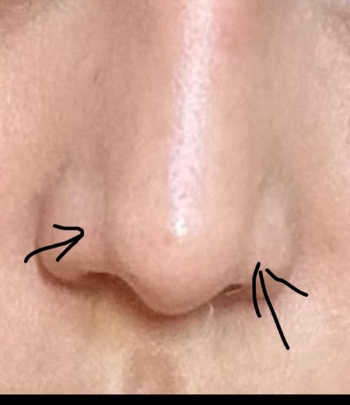 r/PlasticSurgery - alar crease prominent one and a half months after rhinoplasty