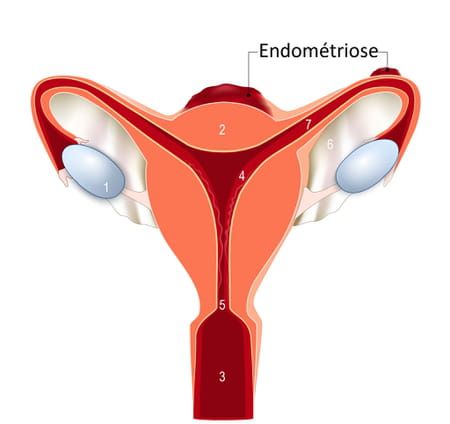 L'endométriose solution naturelle