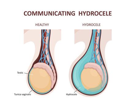 Communicating hydrocele. Testicular disease. Male reproductive system.