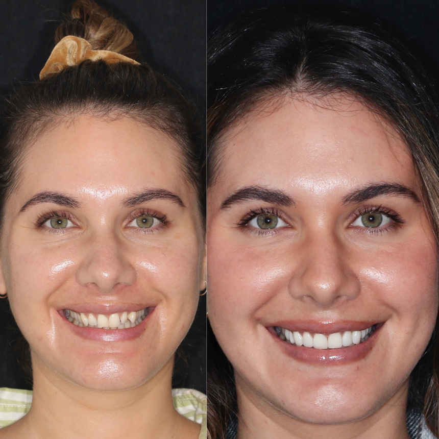 veneers