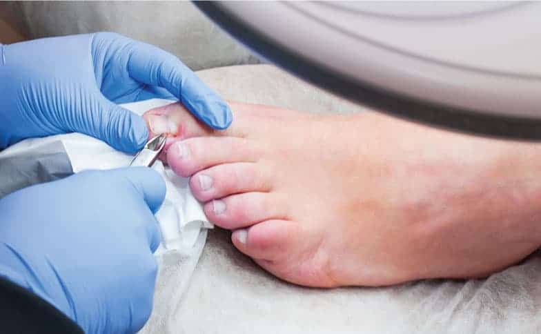Ingrown toenail treatment procedure