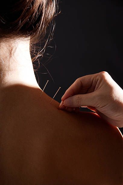 acupuncture needles in woman's neck