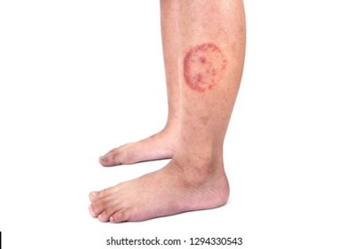 Ringworm infection or Tinea corporis on skin isolated on white background,  Dermatophytosis on skin isolated Stock Photo