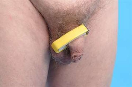 Penile compression device