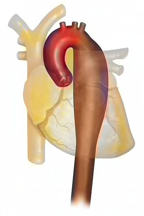 thoracic aortic aneurysm - aortic aneurysm stock illustrations