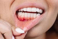 Common Supplements Show Antibiotic-Like Benefits Against Severe Gum Disease - SciTechDaily