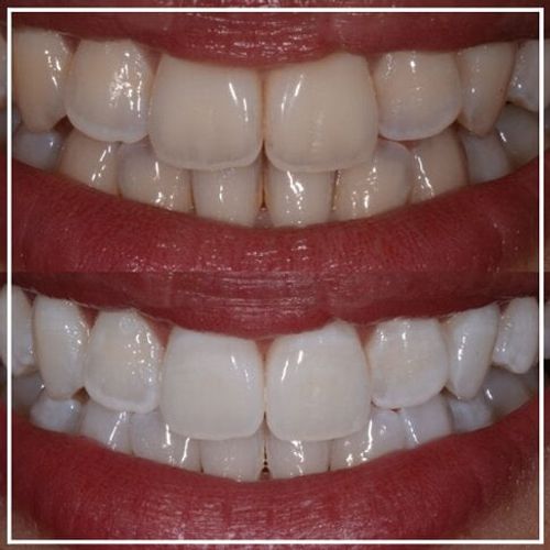 whitening