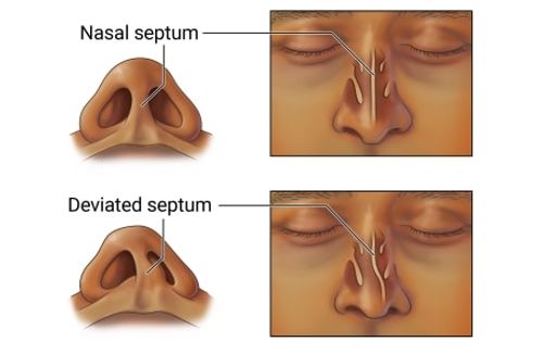 Normal nasal septum and a deviated septum, with views of both looking at head tilted back showing nostrils and at front of face.