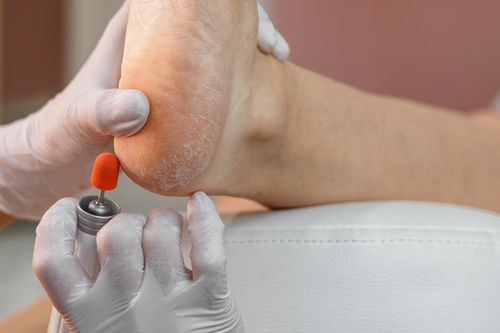 En este momento estás viendo Talones secos: ¿Cómo cuidarlos para evitar sequedad y grietas?