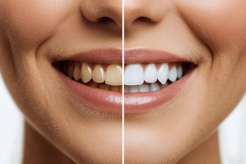 whitening