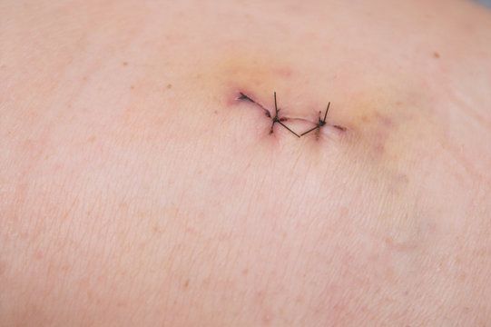 stitches