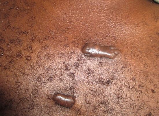 Comment soigner la chéloïdes naturellement