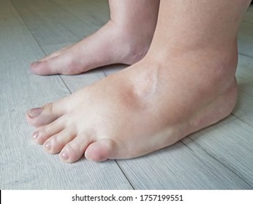 Swollen feets because water retention in the body Stock Photo