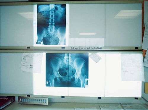 Digital X-Ray