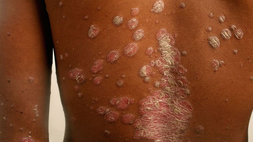 Traitement naturel du psoriasis