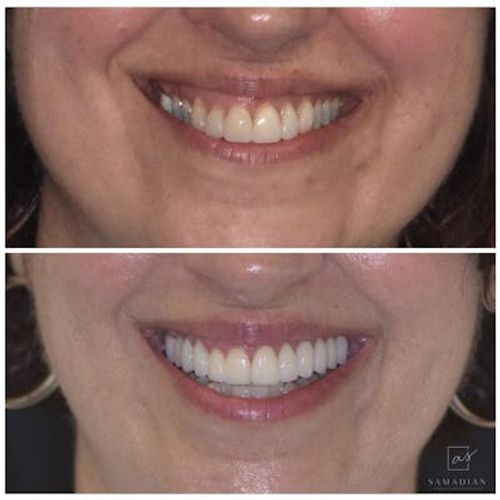 veneers