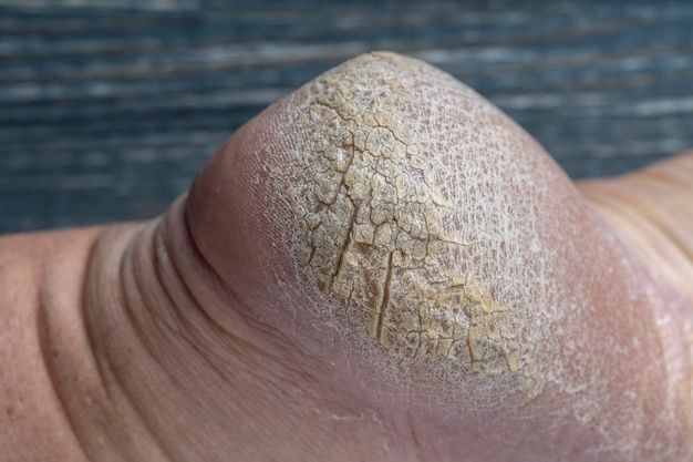 Photo chapped human foot heel crack heel pictures closeup dry and cracked skin on the heel