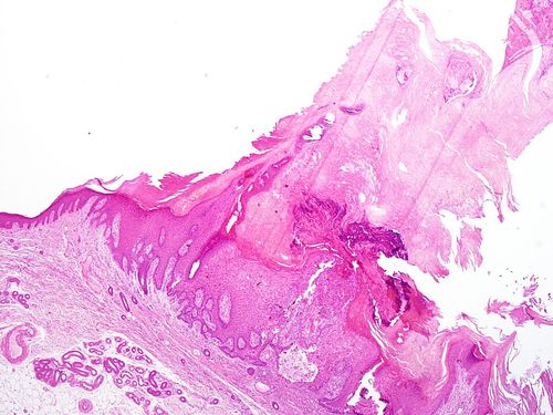 SkinTumors-P5280062.JPG